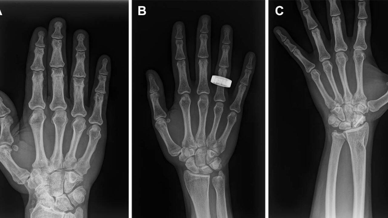 Astronauts Deploy Portable X-ray Technology in Space for First Time