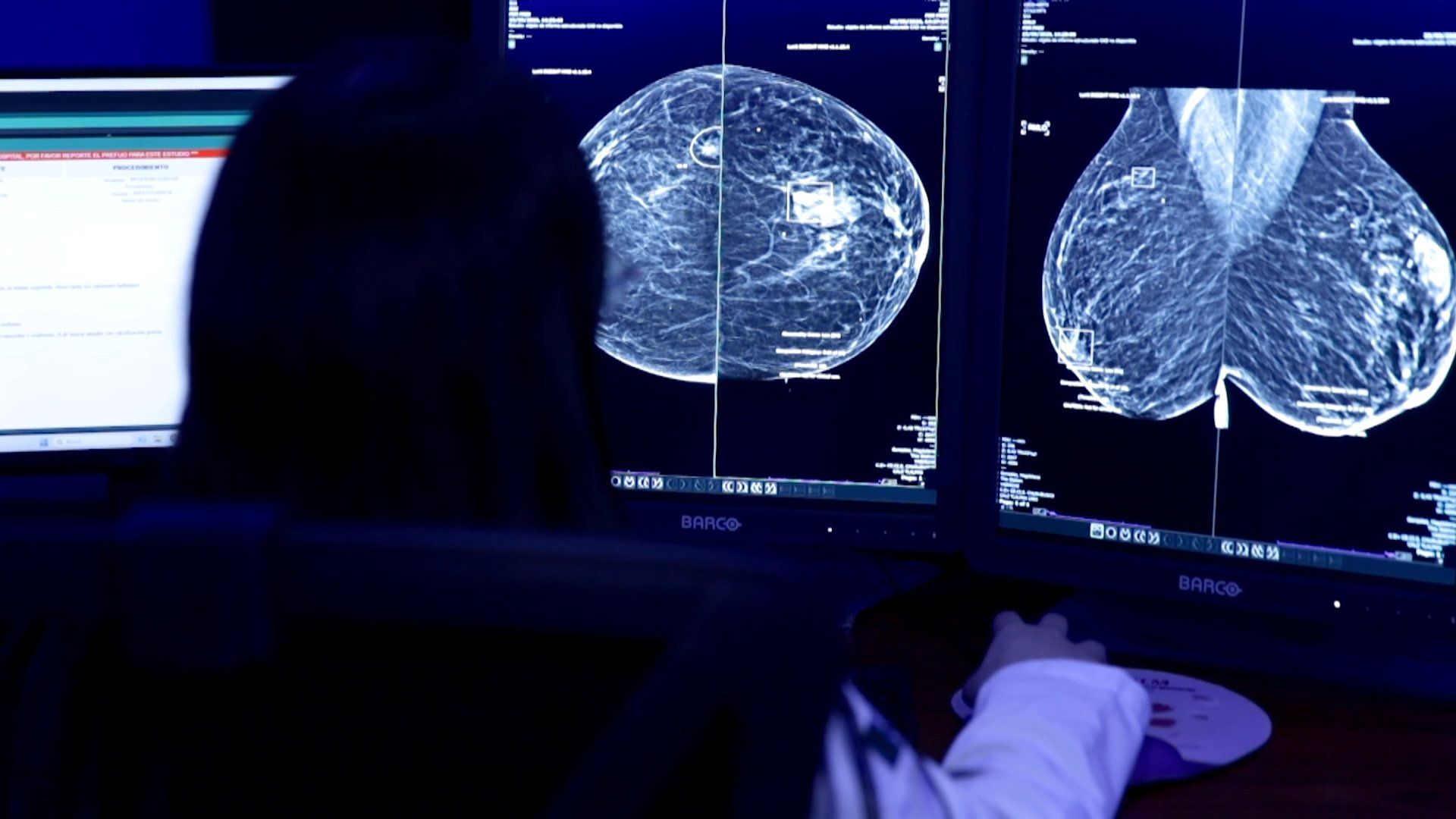 Mexico deploys artificial intelligence to accelerate breast cancer screening