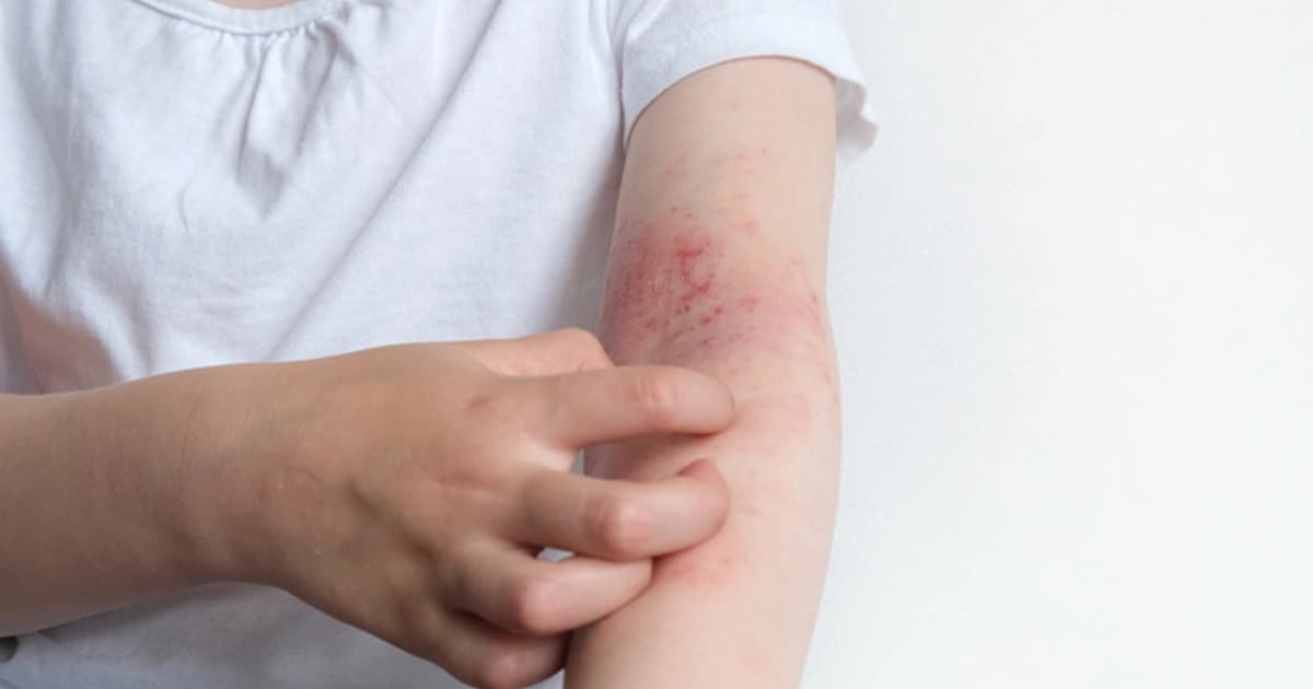 Eczema management: Can the skin condition be cured permanently?