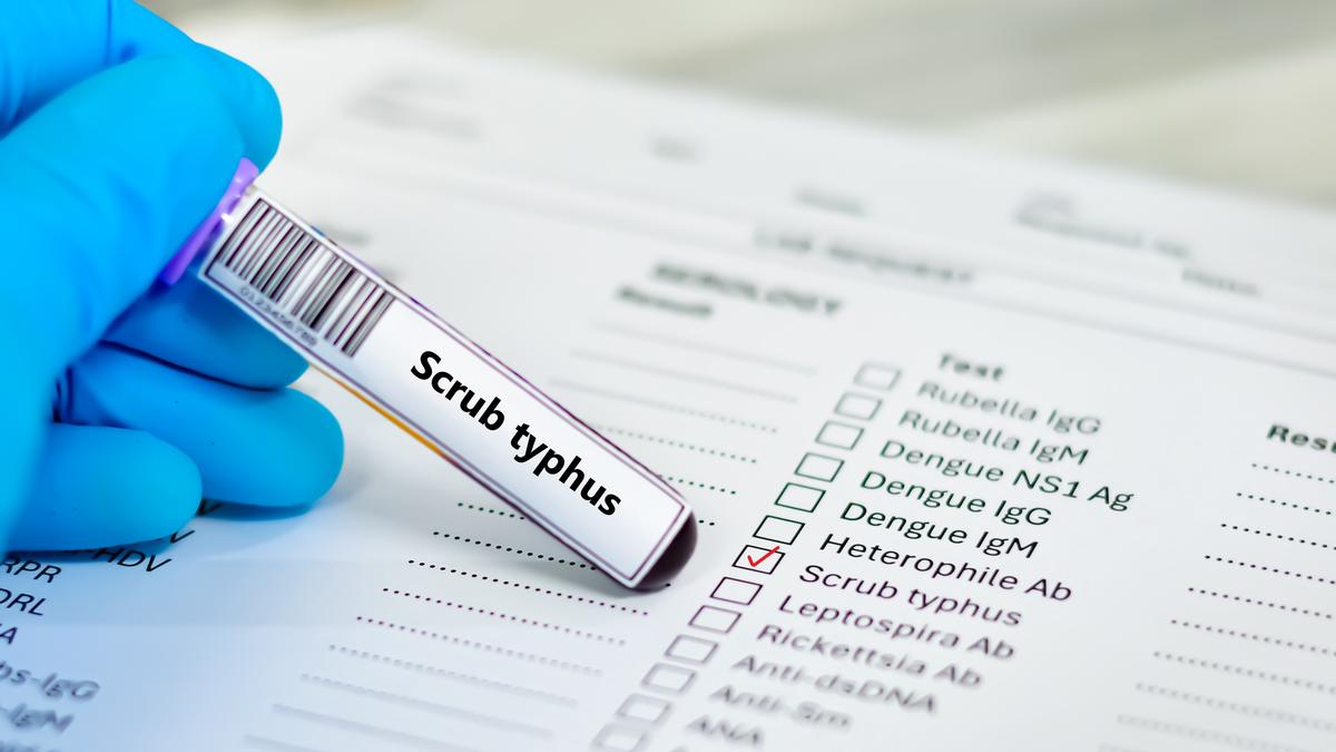 Scrub typhus: Understanding the mite-borne bacterial infection
