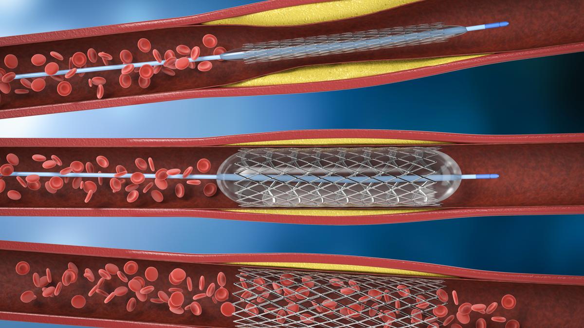 कोरोनरी स्टेंट: क्या हर मामले में जरूरी है?