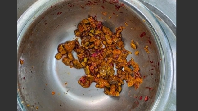 Doctors extract 70 stones from patient's bile duct 29 years after surgery