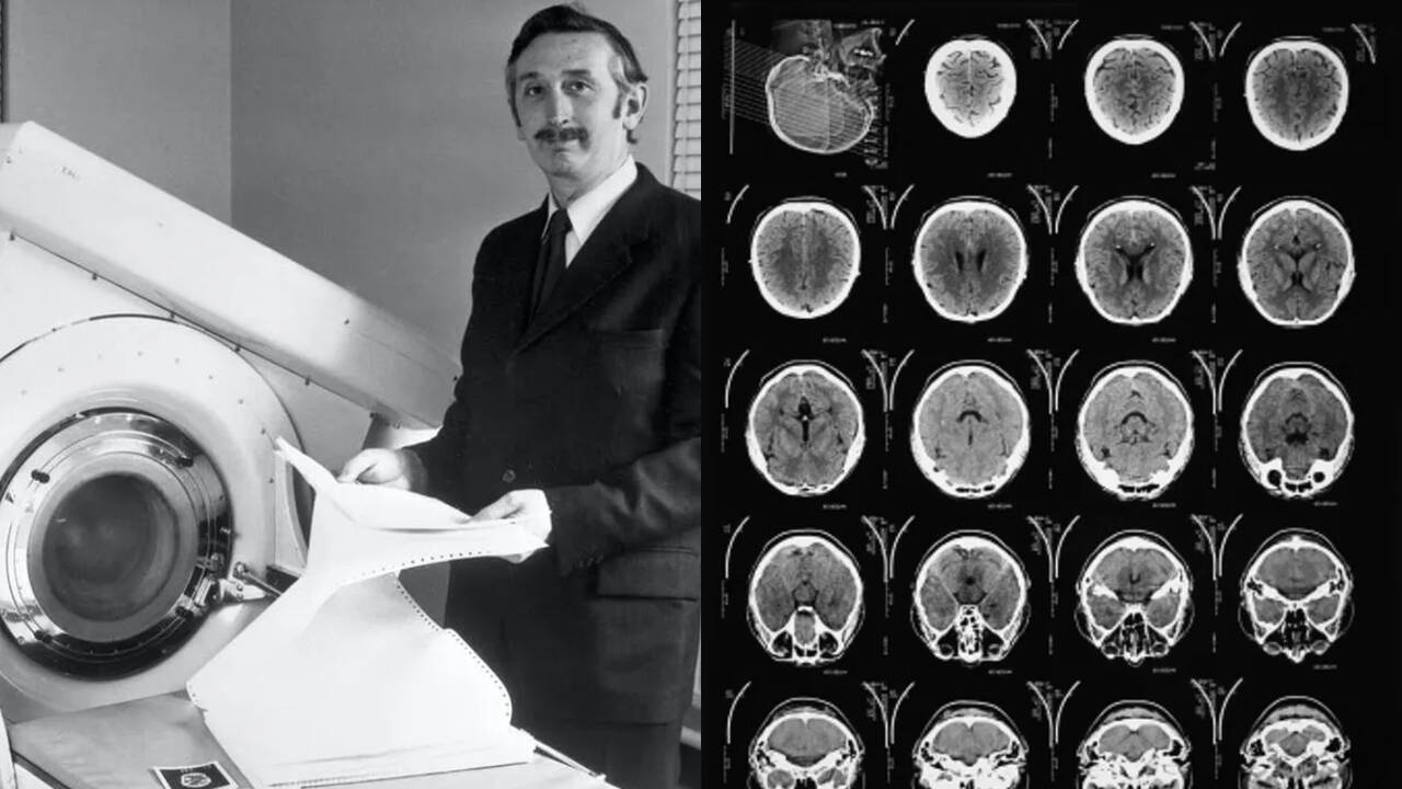 Historic CT scan of 1971 detected brain cyst in groundbreaking first use