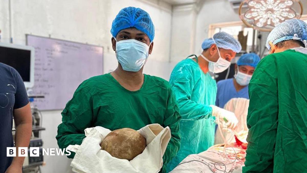 Surgeons extract record-breaking 3.1kg bladder stone from patient