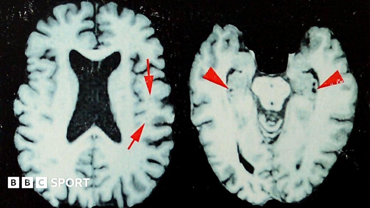 Study reveals widespread brain disease among deceased NFL players