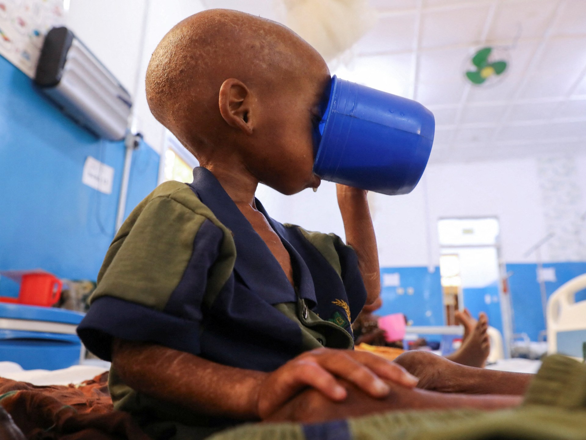 Somalia faces deepening child malnutrition crisis as aid funding dries up
