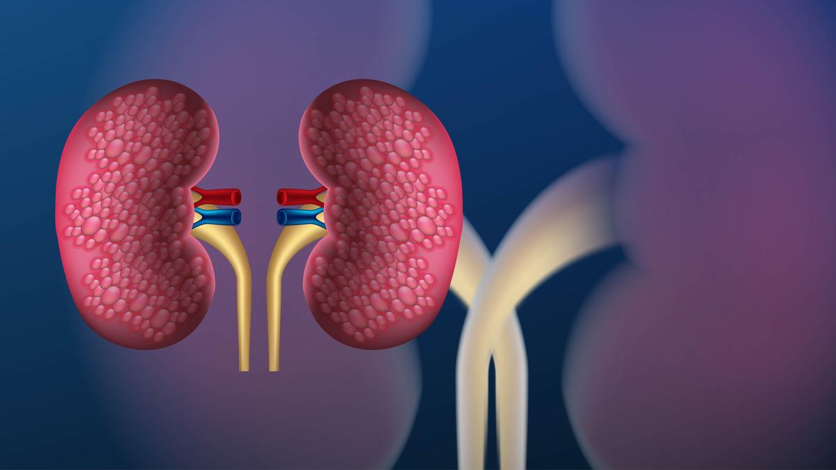 Bengaluru hospital executes innovative kidney swap for child patients
