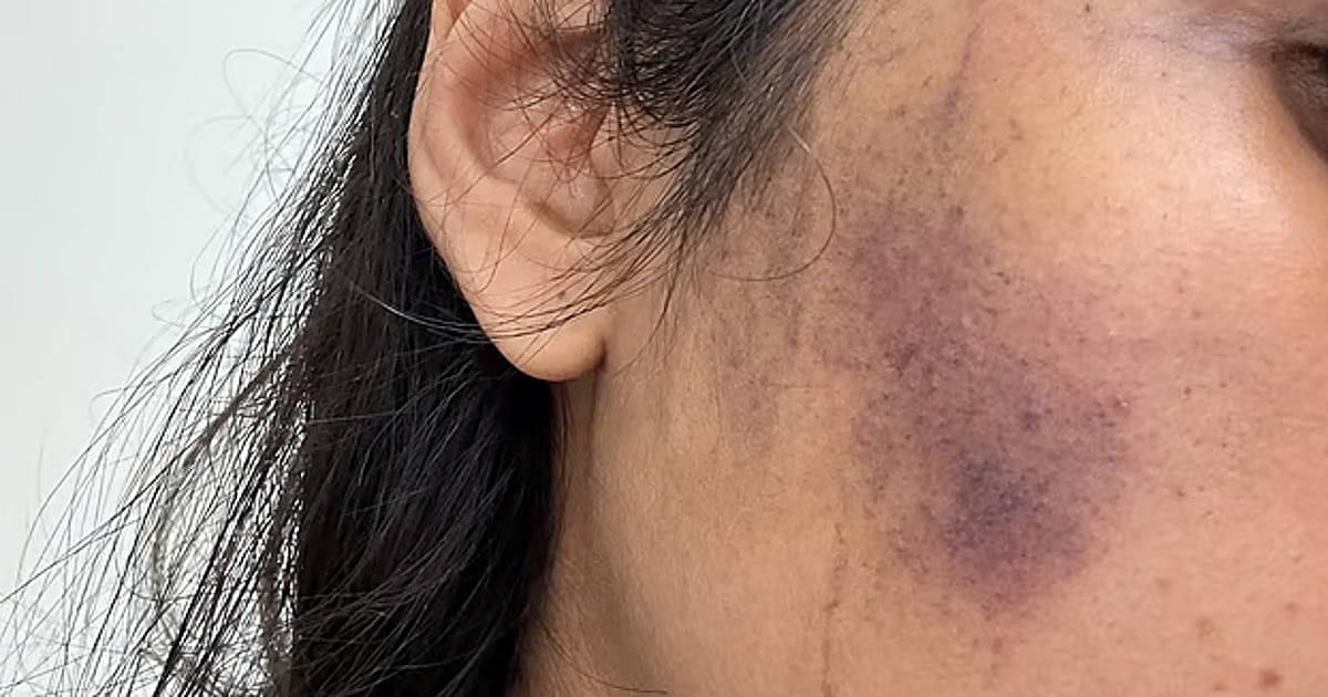 Woman attacked while caring for stray dogs in Dhaka's Banasree