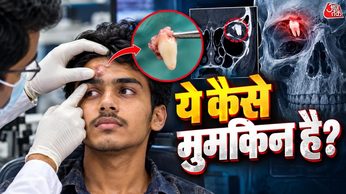 तमिलनाडु में बेहद दुर्लभ मामला: किशोर की आंख के ऊपर मिला विकसित दांत