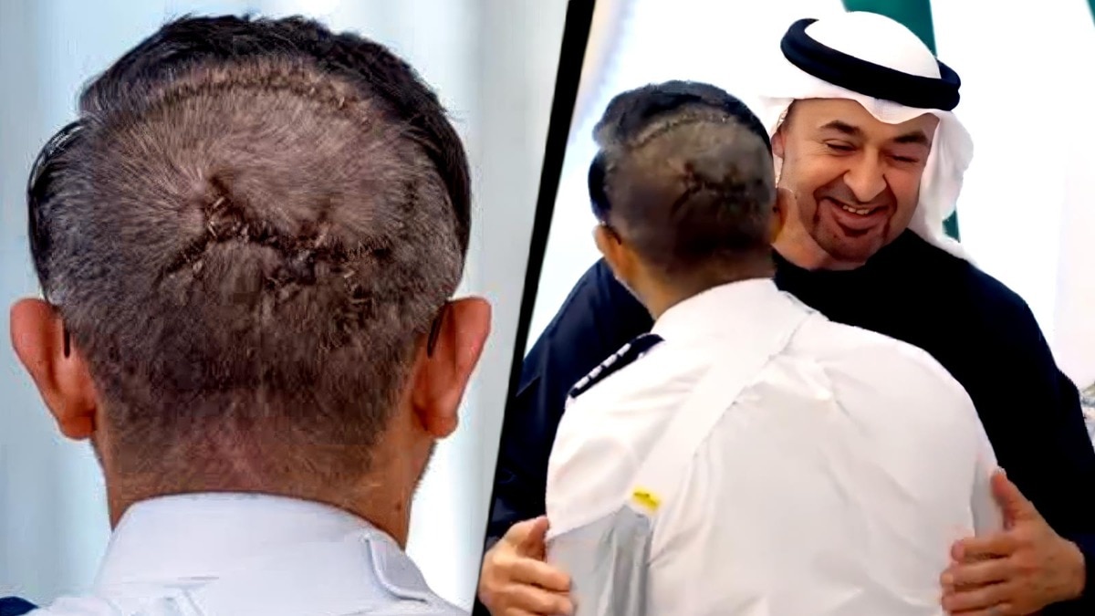 Pilot's Stitched Wounds Tell Story of Heroism on Dubai-Israel Flight