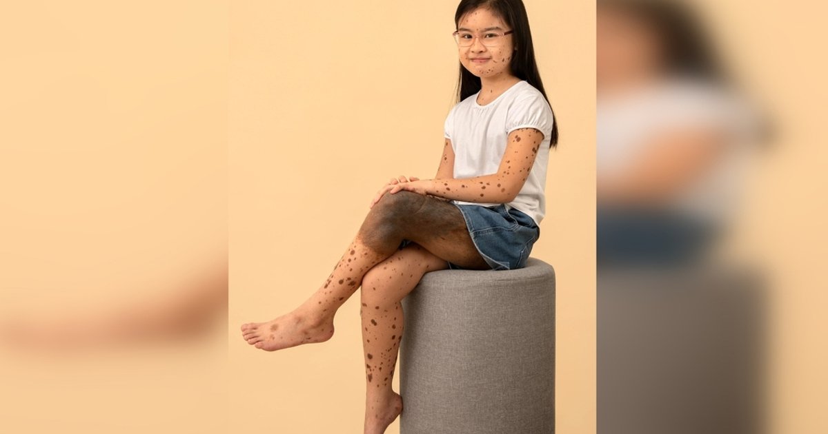 Young girl with rare birthmark finds confidence despite health concerns