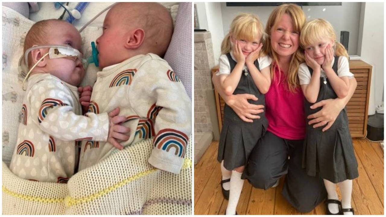 Against odds, twin girls beaten rare syndrome reach school age