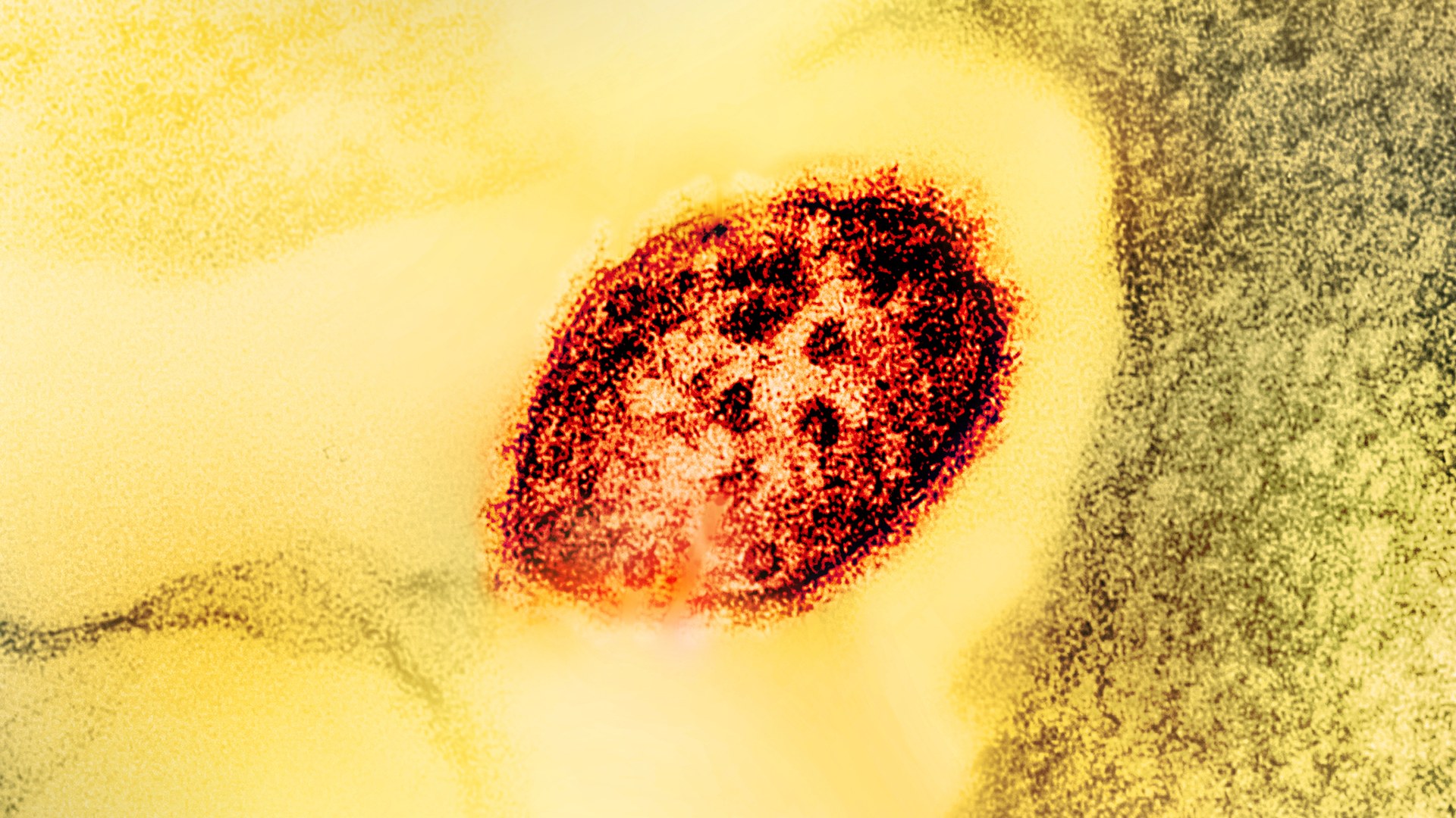 U.S. measles cases surge past previous year's total amid spreading outbreak
