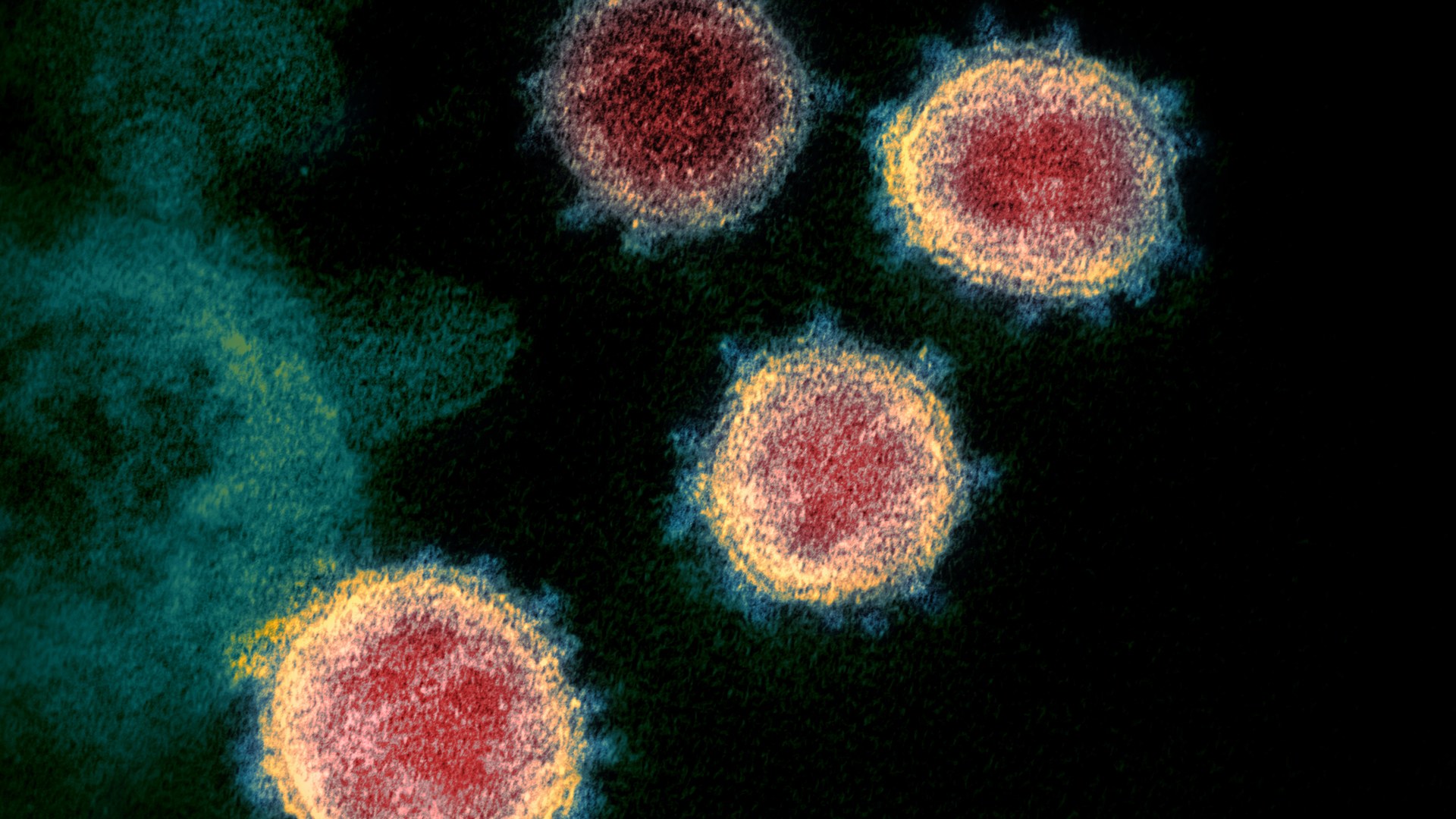 Dormant viruses in human body may unlock long COVID mystery