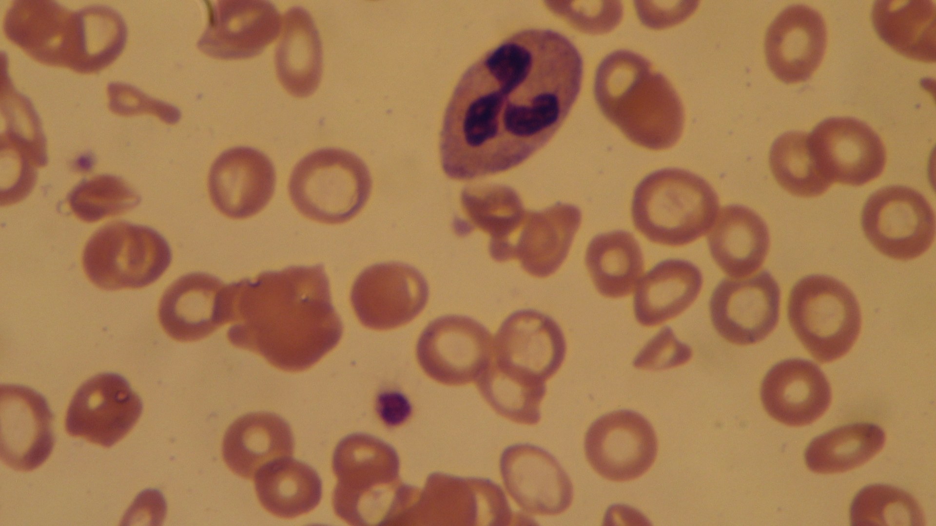 Medical experts debunk 'ferritin face' myth surrounding iron deficiency